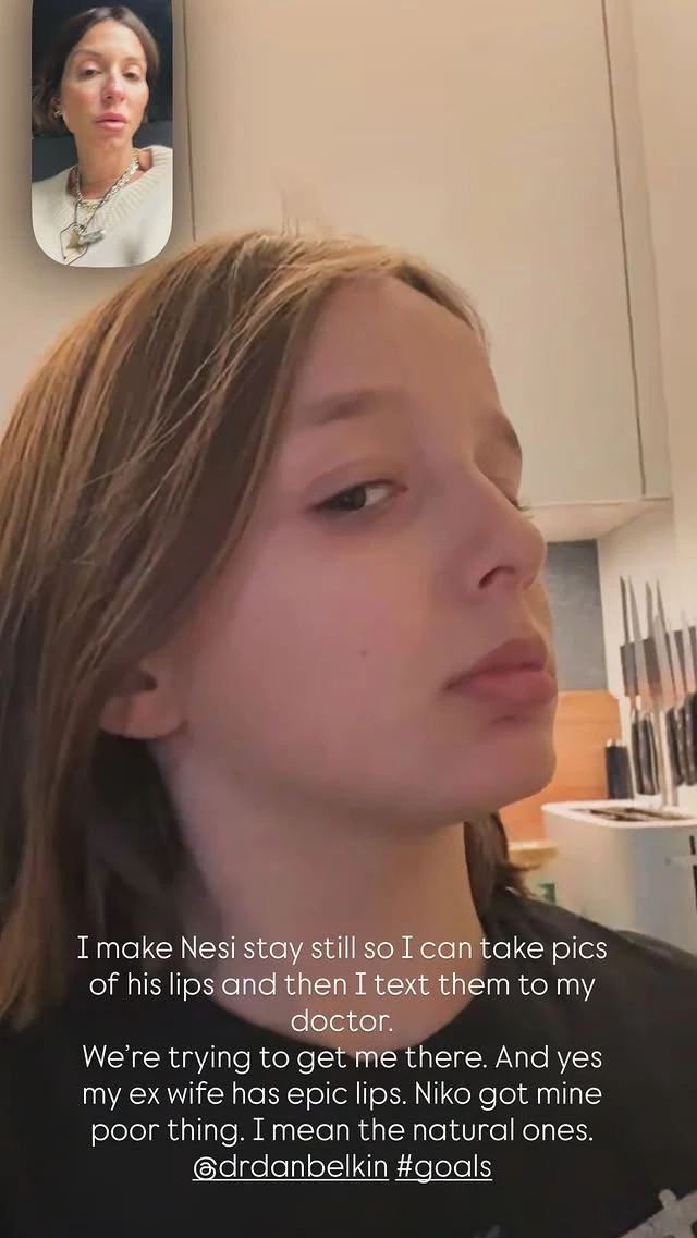 Σοφία Καρβέλα | Αποκαλύπτει την αισθητική επέμβαση που έχει κάνει