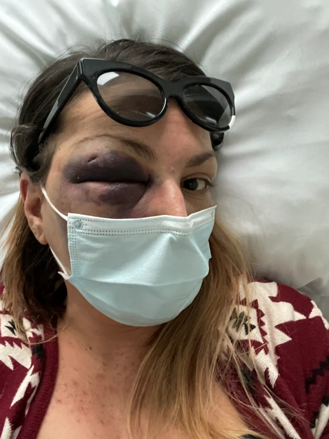 Η food blogger από την Κρήτη δείχνει το πρόσωπό της μετά την κακοποίηση από το σύντροφό της (προσοχή νέες σκληρές εικόνες)