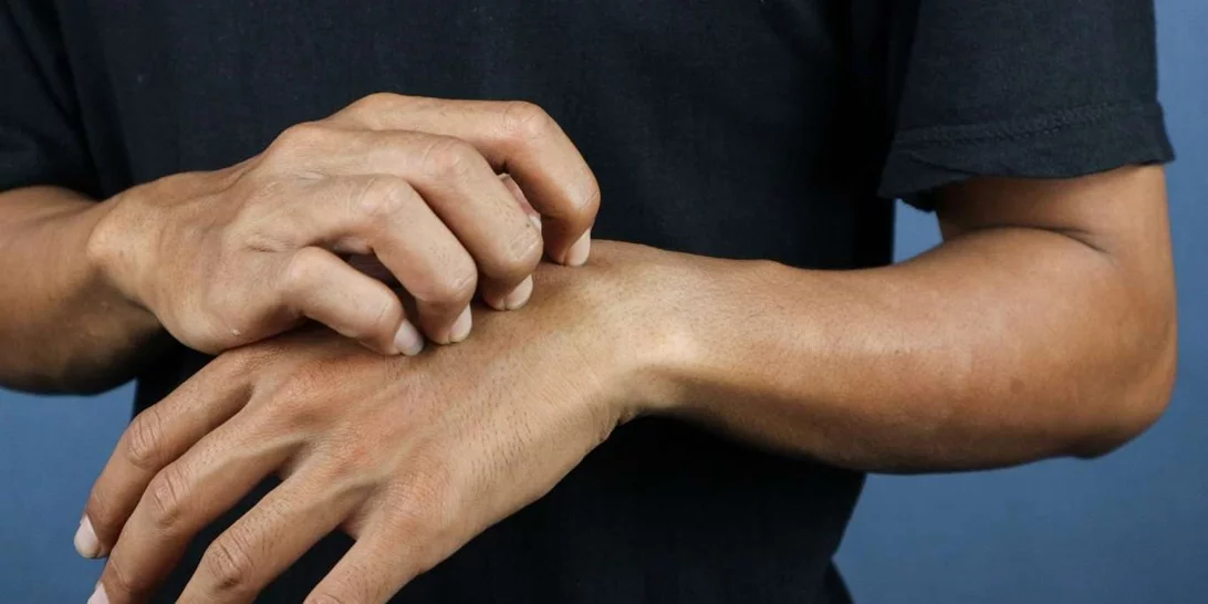 Τα κουνούπια σε τσιμπάνε γιατί είσαι 'γλυκοαίματος' - Τι λέει η επιστήμη, όμως;