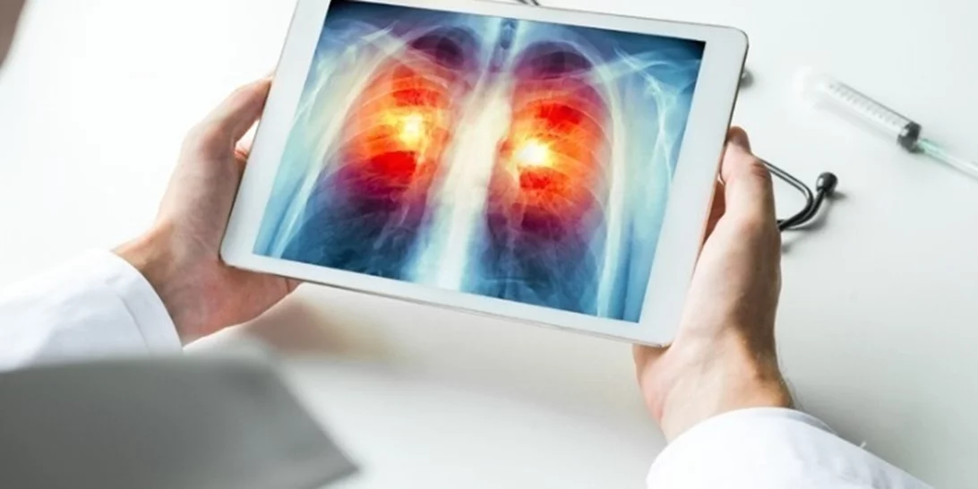 Έρευνα εντοπίζει άγνωστο μοριακό μονοπάτι για την αναχαίτιση του καρκίνου του πνεύμονα