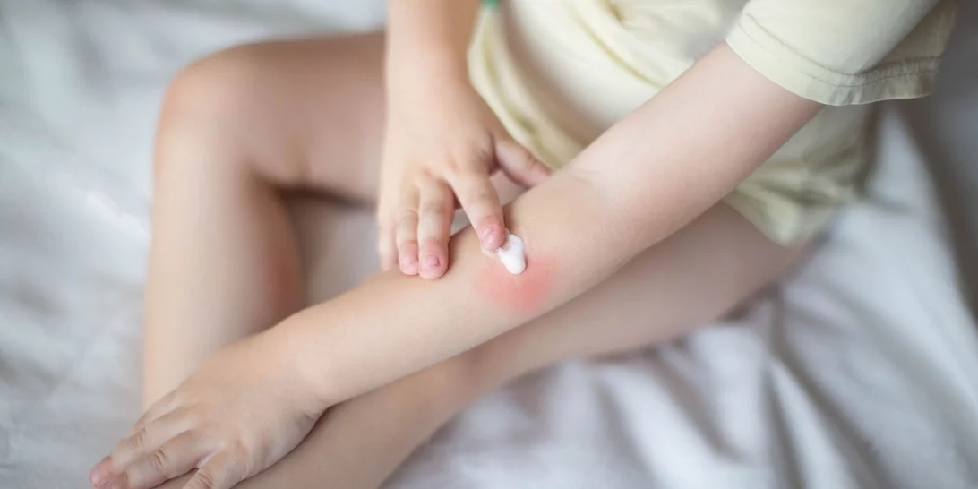 Έγκαυμα στα παιδιά | Τι δεν πρέπει ποτέ να κάνουμε