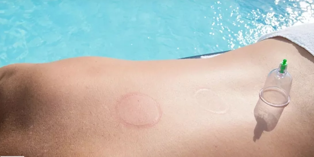 Ολυμπιακοί αγώνες 2024 | Οι βεντούζες τελικά μειώνουν τον πόνο;