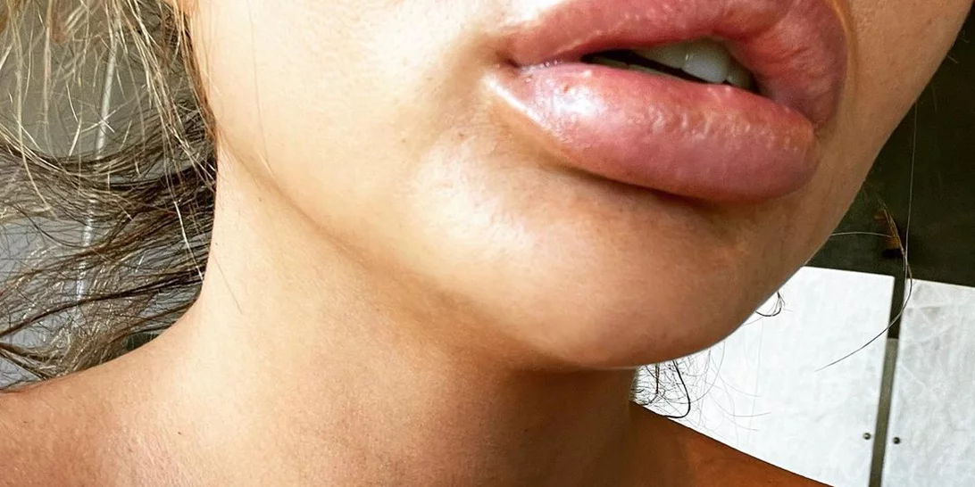 Chrissy Teigen | H φωτο με φουσκωμένα χείλη που προκάλεσε αμέτρητα σχόλια