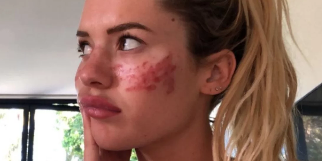 "Μην το δοκιμάσετε στο σπίτι" | Σταρ της τηλεόρασης βρέθηκε στο νοσοκομείο από βίντεο ομορφιάς του Tik Tok