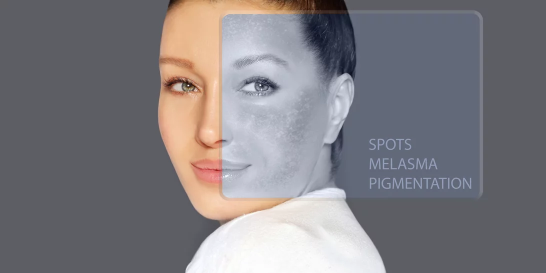 Ποιος φοβάται τις κηλίδες; Όχι εγώ!