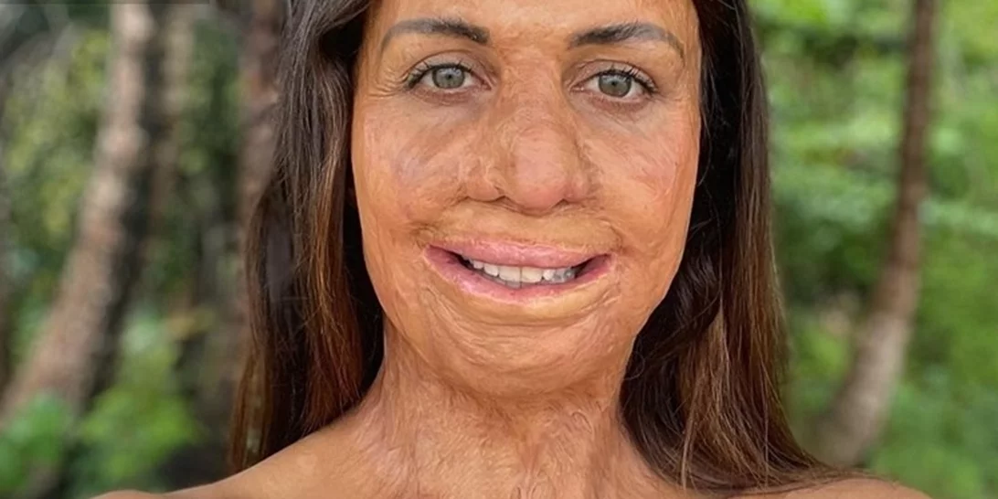 "Το 65% του σώματός μου είχε καεί αλλά επέζησα". Μια τραγική ιστορία επιβίωσης