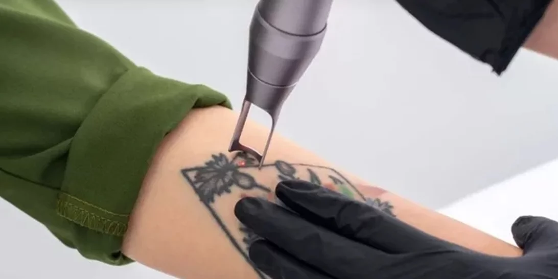 Όλα όσα πρέπει να γνωρίζεις προτού αφαιρέσεις ένα τατουάζ