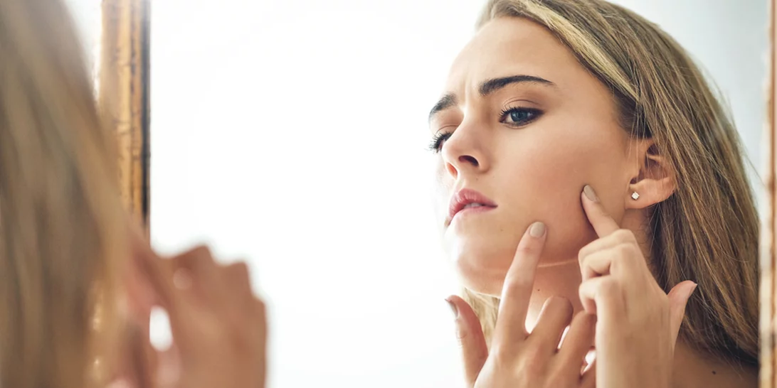 5 μύθοι για την ακμή που ο δερματολόγος σου θα ήθελε να σταματήσεις να πιστεύεις