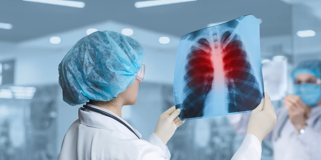 Έλληνες ερευνητές ενώνουν τις δυνάμεις τους για να λύσουν το γρίφο των σοβαρών λοιμώξεων του αναπνευστικού και των επιπλοκών τους