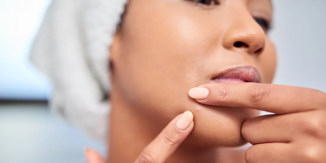 Όλα τα tips που χρειάζεσαι για να απαλλαγείς από τα σπυράκια στο πηγούνι