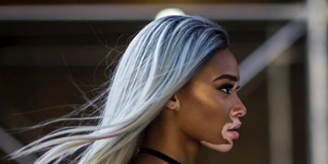 Winnie Harlow: Το μοντέλο που πάσχει από λεύκη γίνεται viral μέσα από μία συγκινητική ανάρτηση