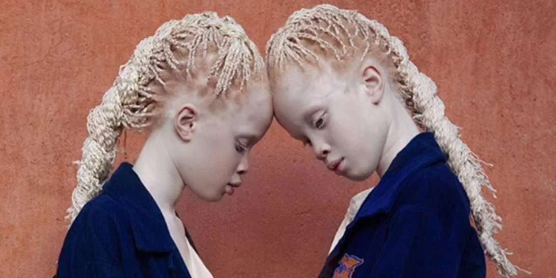 Γιατί είναι διάσημα αυτά τα δίδυμα με αλμπινισμό;