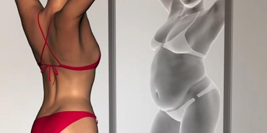 Νευρική ανορεξία και παχυσαρκία: Γιατί ενισχύονται ταυτόχρονα οι διατροφικές διαταραχές στην Ελλάδα;