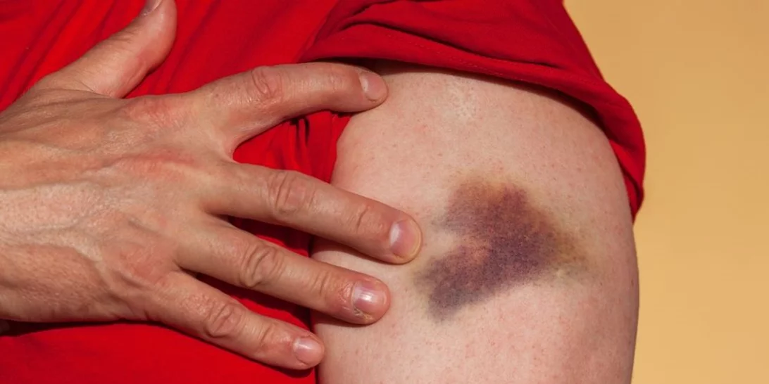 Γι' αυτούς τους λόγους μελανιάζεις με το παραμικρό