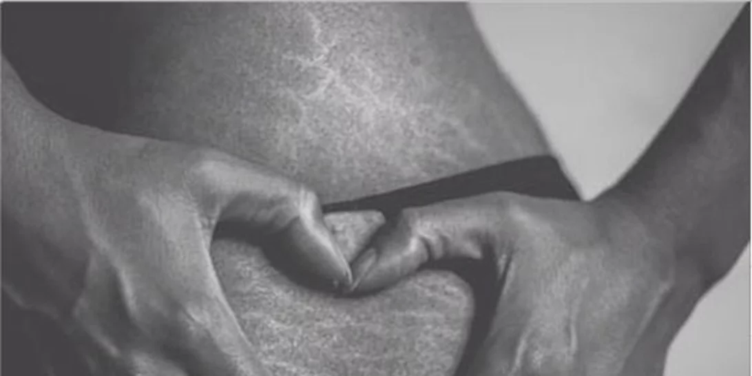 Αυτή η κοπέλα κάλυψε τις ραγάδες της με glitter και σου λέει να αγαπάς τον εαυτό σου