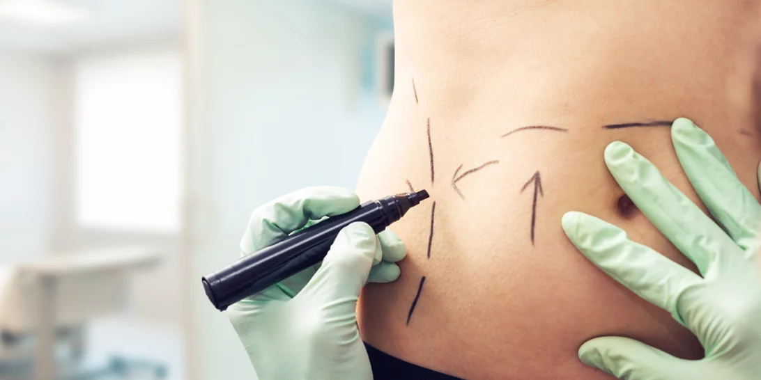 Λιποαναρρόφηση χωρίς νυστέρι για τέλειο κορμί με άμεση επαναφορά!