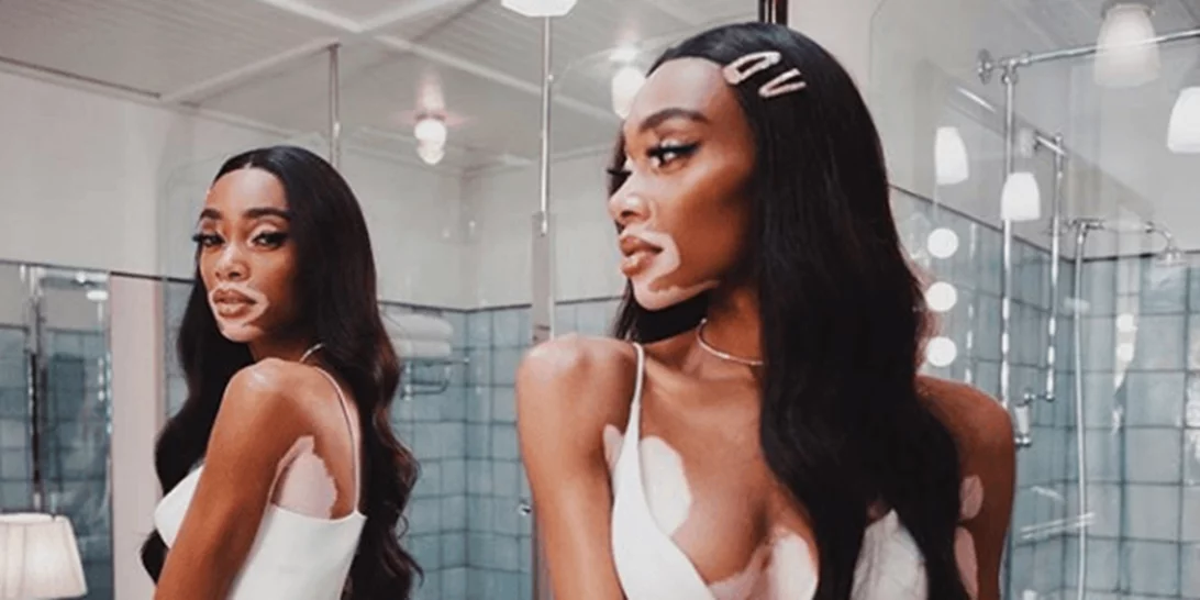 Η Winnie Harlow «ζήλεψε» τα μαλλιά της Kylie Jenner και ορίστε τι χρώμα τα έκανε