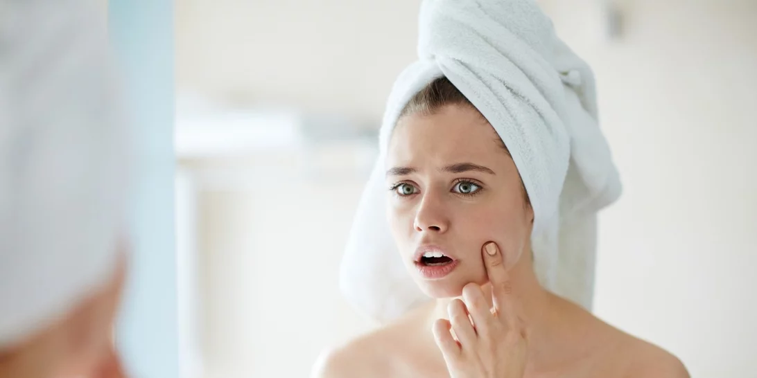 DIY τρόποι για να αντιμετωπίσεις την ξαφνική εμφάνιση ακμής