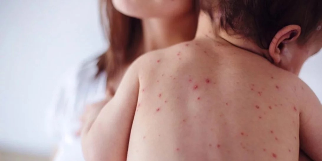 ΠΟΥ: Ανησυχία για την ιλαρά στην Ελλάδα