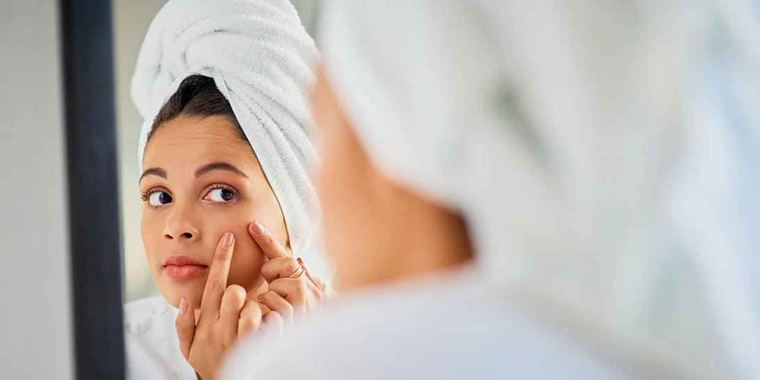 Πώς να σταματήσω να πειράζω τα σπυράκια; 5 εγγυημένοι τρόποι να δώσεις τέλος σε αυτήν την κακή συνήθεια!