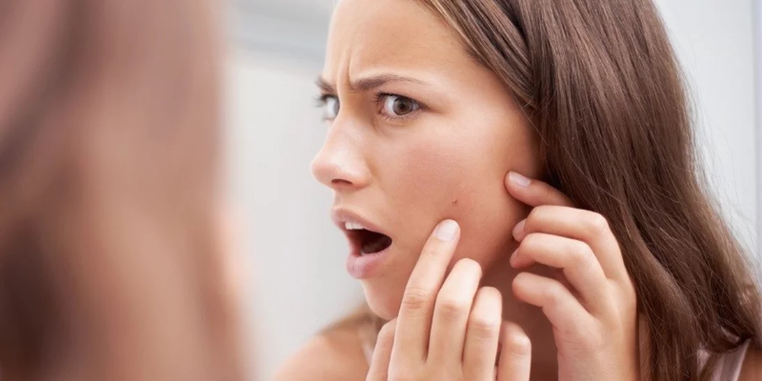 Έβγαλες σπυράκι. Και τώρα; Να τι πρέπει να κάνεις!