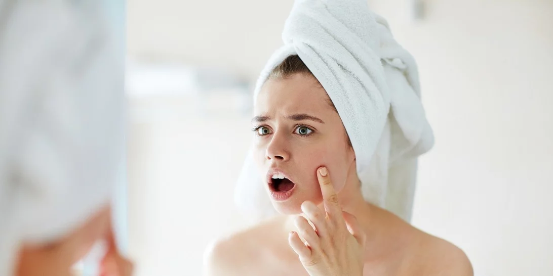 Ακμή; 5 tips για να ξεκινήσεις να την αντιμετωπίζεις από σήμερα κιόλας