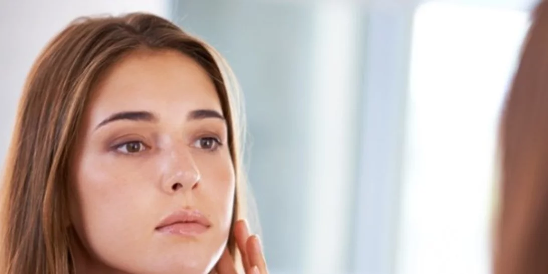 Γιατί έχεις ακόμα ακμή και τι πρέπει να προσέξεις για να τη μειώσεις;