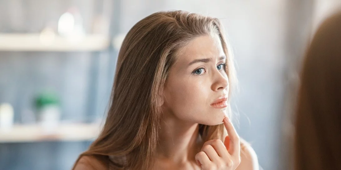 Ακμή στο πηγούνι | Σε τι οφείλεται και πώς μπορείς να την αντιμετωπίσεις