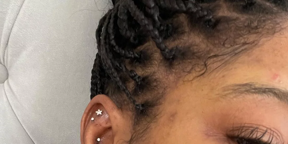 Πασίγνωστη star ποζάρει χωρίς makeup και αποκαλύπτει τη μάχη της με την ακμή