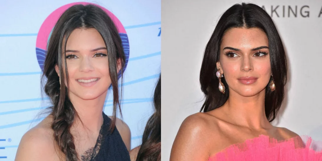 Οι πλαστικές επεμβάσεις των celebrities | Δες το πριν και το μετά