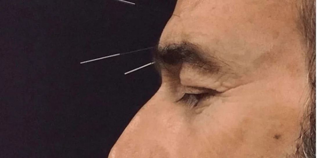 «Ο βελονισμός είναι από τις αρχαιότερες θεραπείες» | Η νέα φωτογραφία του Θανάση Ευθυμιάδη στο Instagram