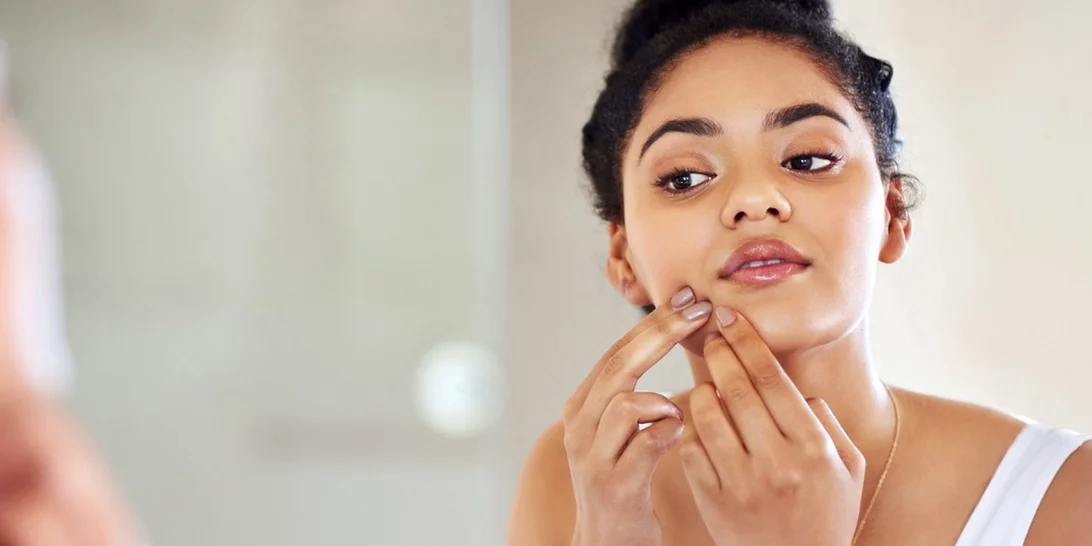 FYI Τα μικρά άσπρα σπυράκια στο πρόσωπό σου δεν είναι (ακριβώς) ακμή