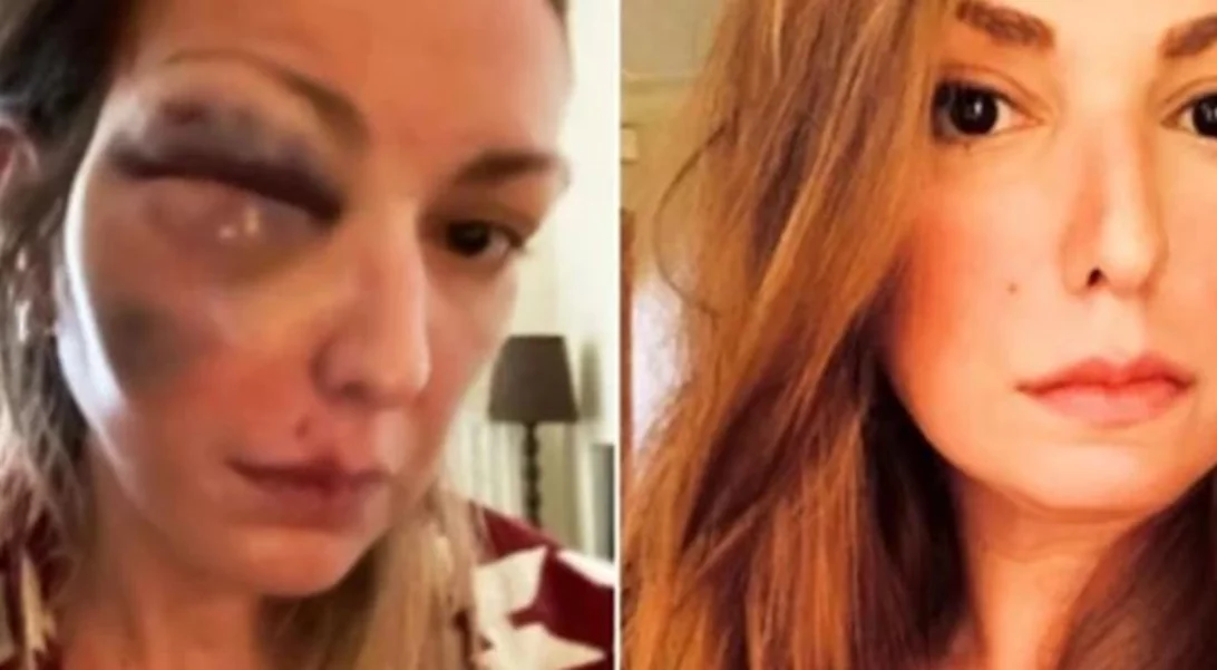 Σοκάρει γνωστή Ελληνίδα food blogger, η οποία έπεσε θύμα κακοποίησης | Οι φωτογραφίες μετά τον ξυλοδαρμό