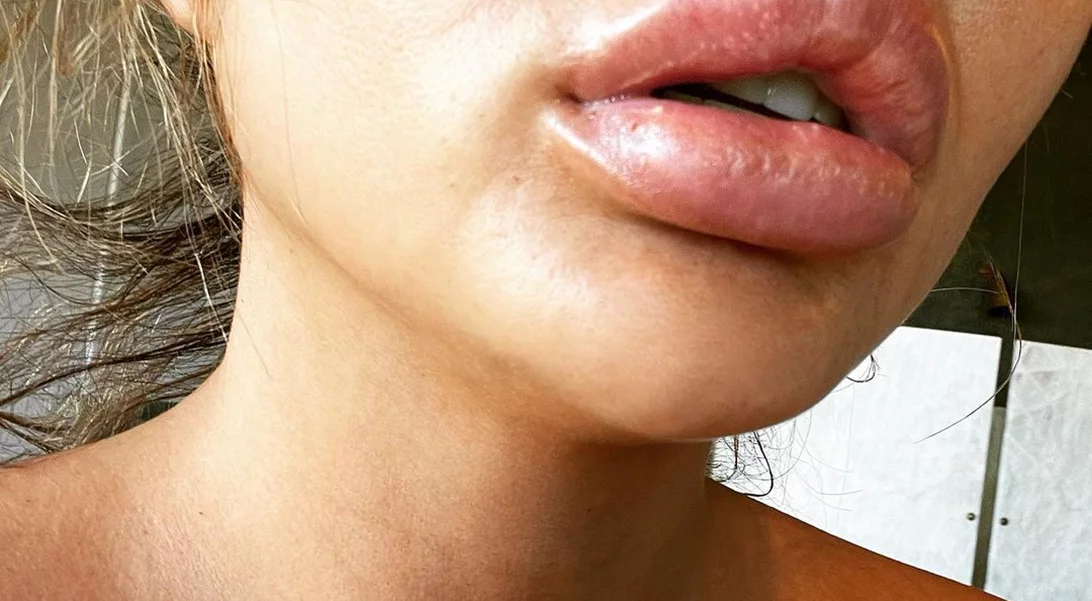 Chrissy Teigen | H φωτο με φουσκωμένα χείλη που προκάλεσε αμέτρητα σχόλια