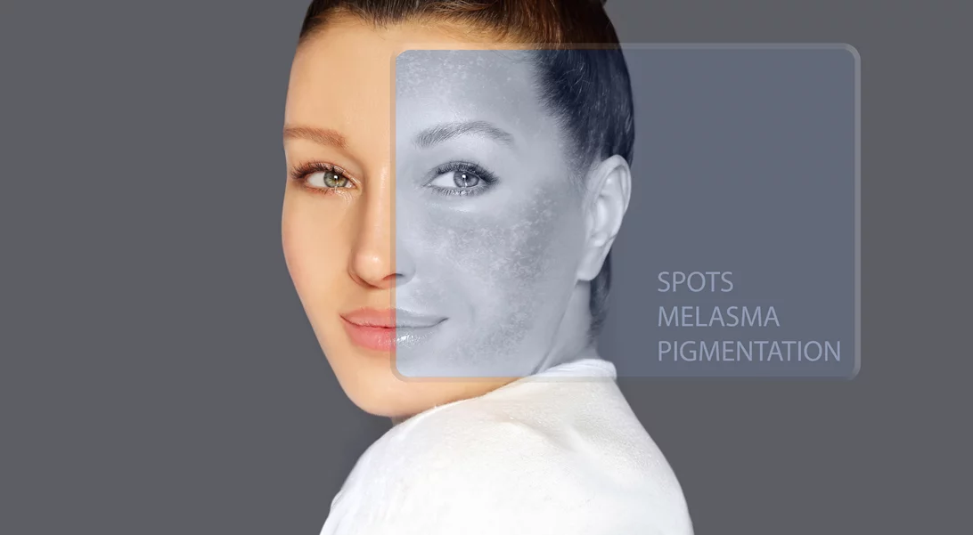 Ποιος φοβάται τις κηλίδες; Όχι εγώ!