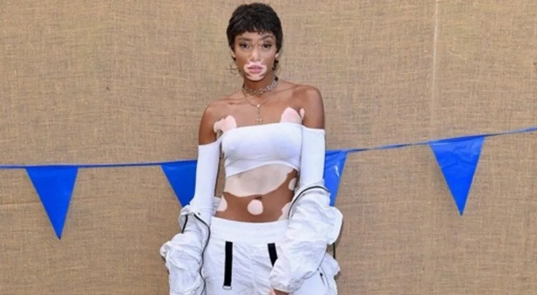 Winnie Harlow, Rain Dove και ακόμη τέσσερα αντισυμβατικά μοντέλα!