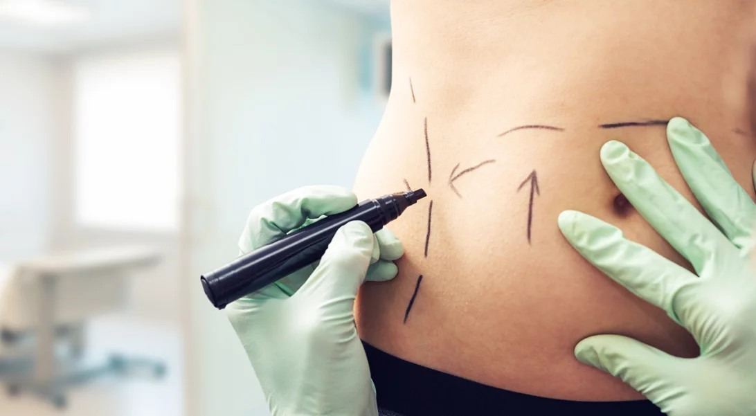 Λιποαναρρόφηση χωρίς νυστέρι για τέλειο κορμί με άμεση επαναφορά!