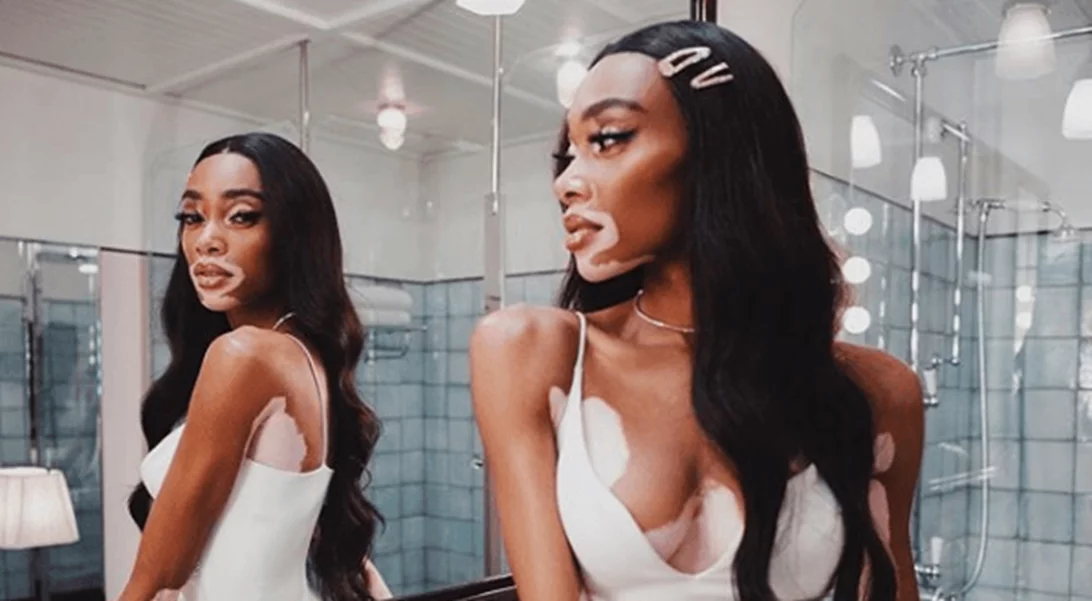 Η Winnie Harlow «ζήλεψε» τα μαλλιά της Kylie Jenner και ορίστε τι χρώμα τα έκανε