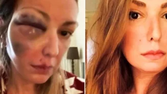 Σοκάρει γνωστή Ελληνίδα food blogger, η οποία έπεσε θύμα κακοποίησης | Οι φωτογραφίες μετά τον ξυλοδαρμό