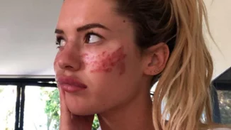 "Μην το δοκιμάσετε στο σπίτι" | Σταρ της τηλεόρασης βρέθηκε στο νοσοκομείο από βίντεο ομορφιάς του Tik Tok