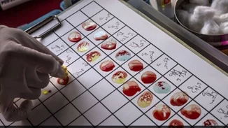 Έρευνα | Δεν έχουν όλες οι ομάδες αίματος τον ίδιο κίνδυνο για εγκεφαλικό πριν τα 60