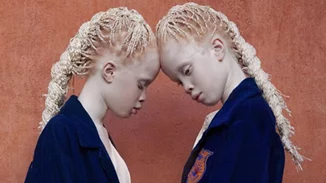 Γιατί είναι διάσημα αυτά τα δίδυμα με αλμπινισμό;