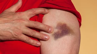 Γι' αυτούς τους λόγους μελανιάζεις με το παραμικρό