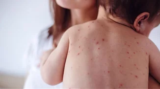 ΠΟΥ: Ανησυχία για την ιλαρά στην Ελλάδα