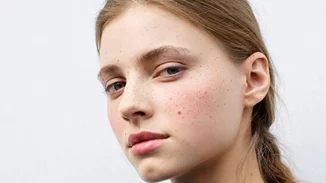 Ακμή | 5 μύθοι καταρρίπτονται