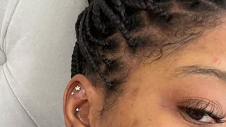 Πασίγνωστη star ποζάρει χωρίς makeup και αποκαλύπτει τη μάχη της με την ακμή