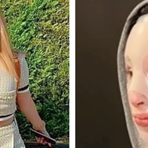 Επίθεση με βιτριόλι | "Επίπονο, αλλά θα πάω στο δικαστήριο", λέει η Ιωάννα