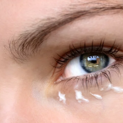 Ταλαιπωρείσαι από μαύρους κύκλους στα μάτια; Ο εύκολος τρόπος για να απαλλαχθείς από αυτούς μια και καλή