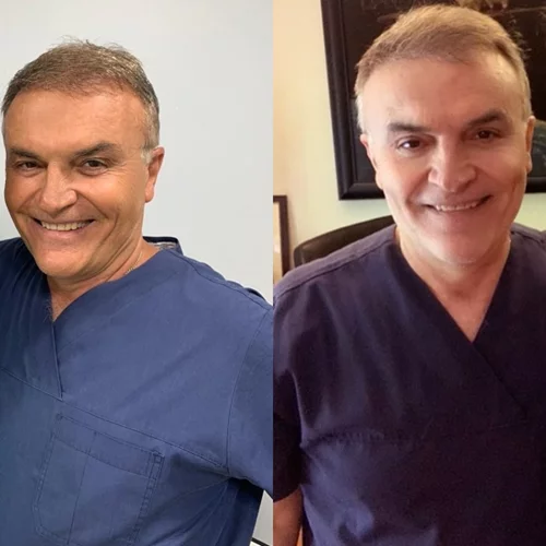 Κρατερός Κατσούλης | Έκανε εμφύτευση μαλλιών και δείχνει το πριν και το μετά