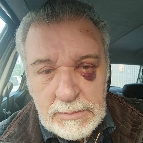 Τάσος Χαλκιάς | Ατύχημα για τον ηθοποιό (εικόνα)